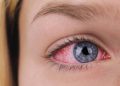 Hậu covid mắt đỏ có nguy hiểm không?