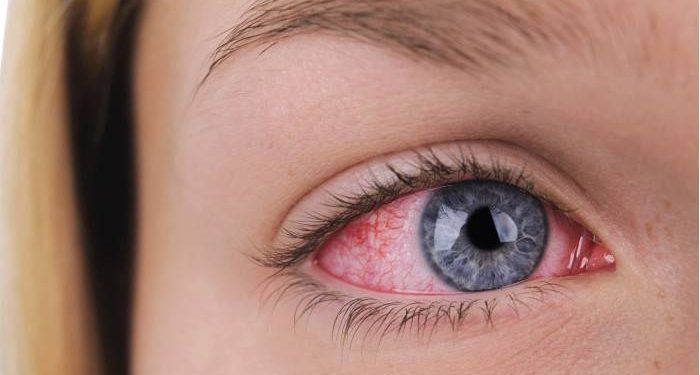 Hậu covid mắt đỏ có nguy hiểm không?