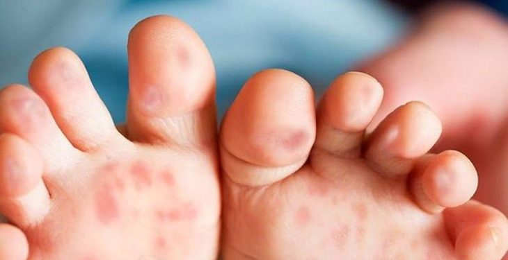 Cảnh báo những dấu hiệu bệnh tay chân miệng ở trẻ sơ sinh